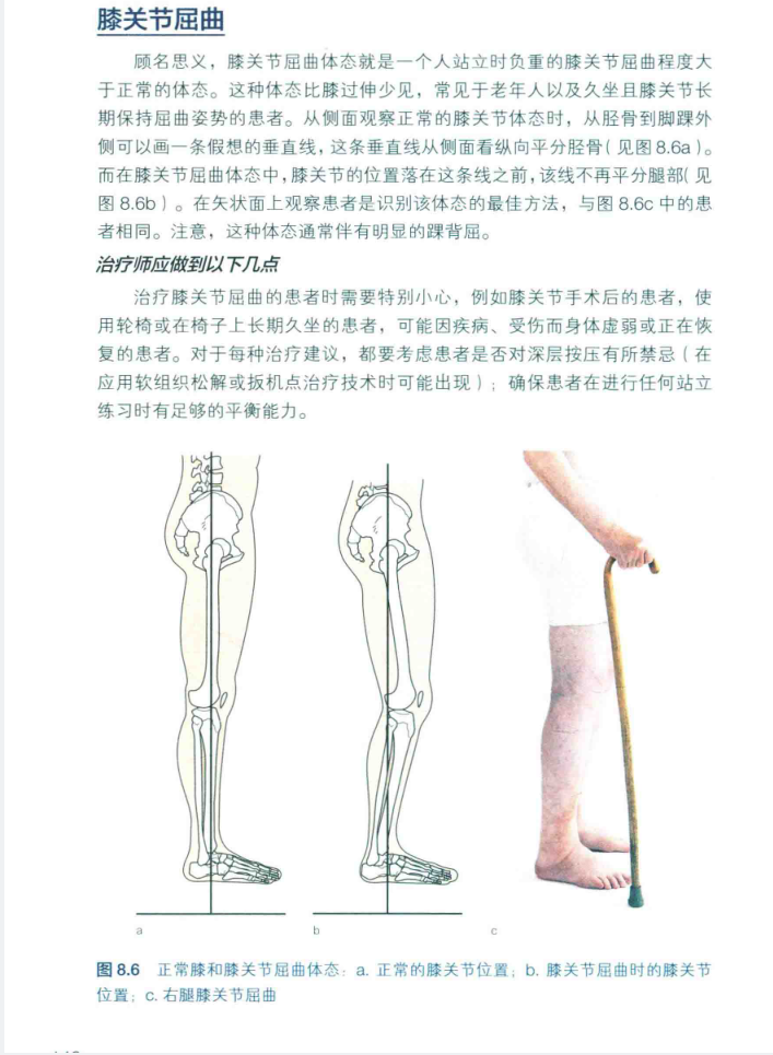 图片展示了膝关节屈 addCriterion屈曲体态的示例。图a为正常膝关节位置,图b为膝关节屈曲时的膝关节位置,图c为右腿膝关节屈曲。该图片与上下文紧密相关,上下文在介绍膝关节屈曲体 addCriterion体态,即站立时负重的膝关节屈曲程度大于正常体态,常见于老年人及久坐且膝关节长期保持屈曲姿势的患者,此图直观呈现了正常与屈曲时 addCriterion的膝关节位置差异,帮助理解上下文对膝关节屈曲体态的描述。